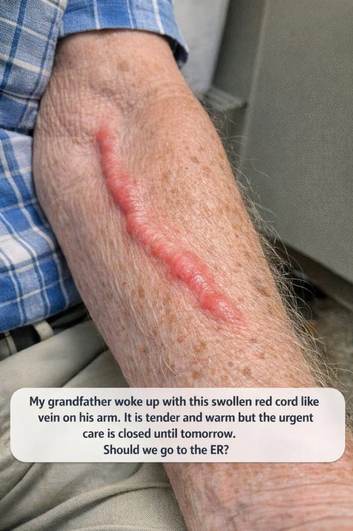 Swollen Red Cord-Like Vein on Arm
